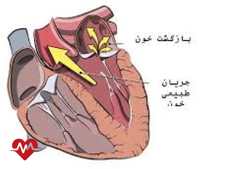 نارسایی دریچه آئورت