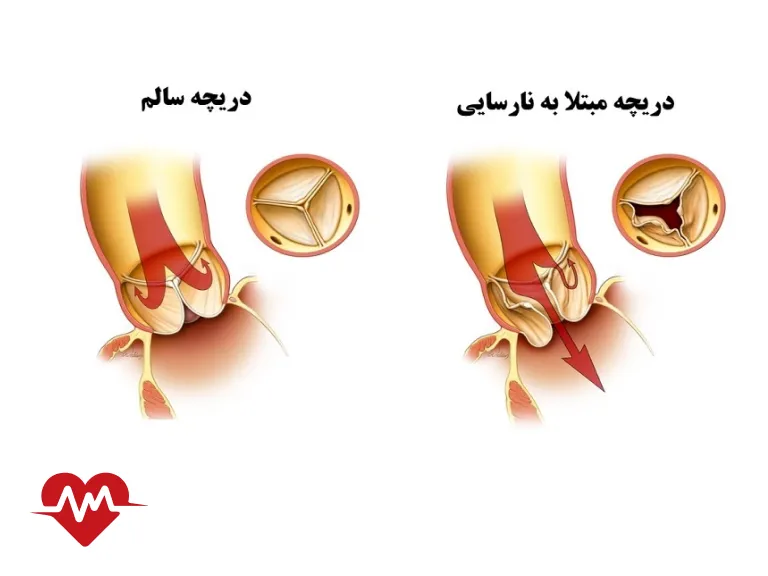 نارسایی دریچه آئورت