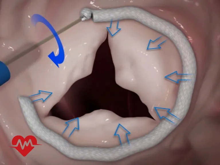 دریچه سه لتی