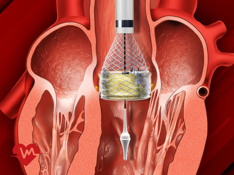 عمل تعویض دریچه قلب چند ساعت طول می کشد