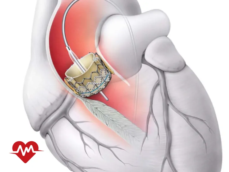 عمل تعویض دریچه قلب چند ساعت طول می کشد