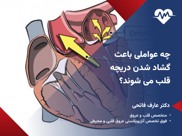 علت گشادی دریچه قلب