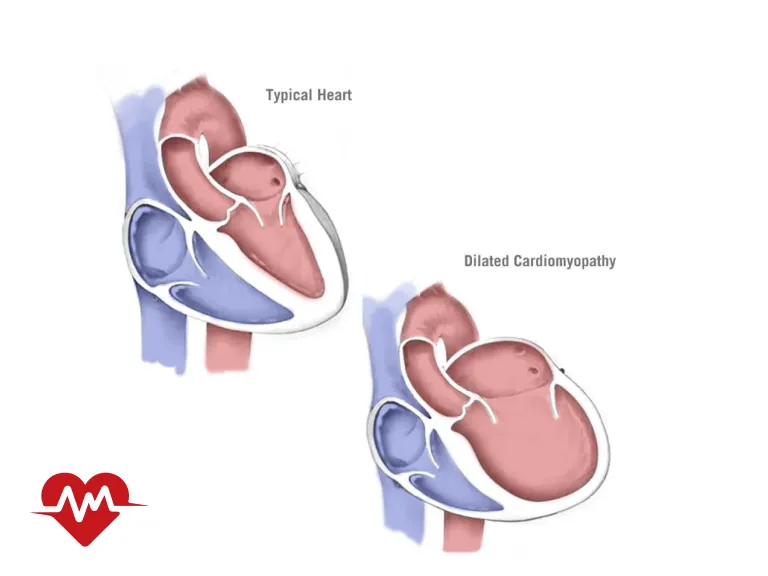 عوارض گشادی دریچه قلب