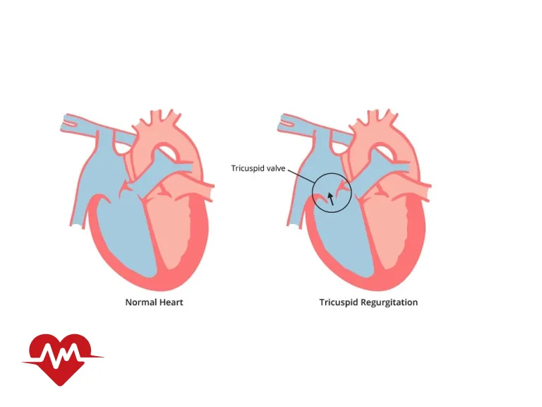 نارسایی دریچه تریکوسپید قلب