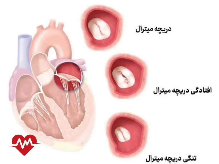 افتادگی دریچه آئورت