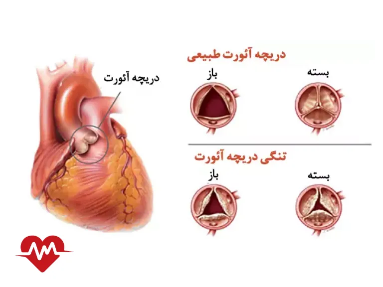 بیماری دریچه قلب