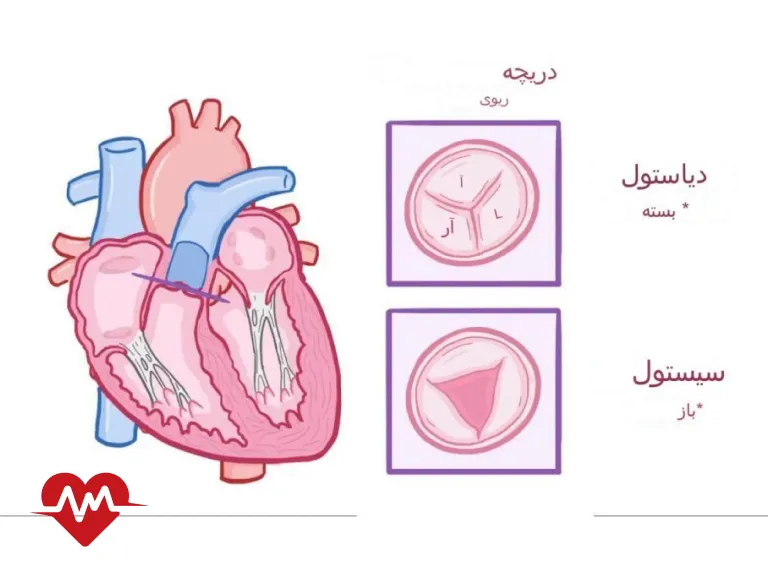 گشادی دریچه ریوی قلب چیست و چگونه درمان می شود؟