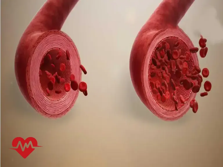 عوارض گشادی دریچه قلب