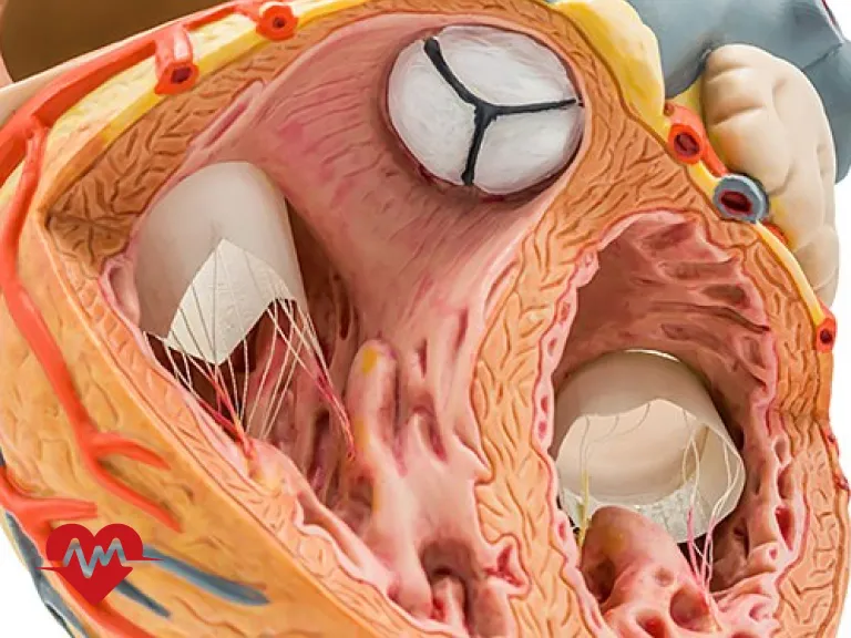 نارسایی دریچه تریکوسپید قلب