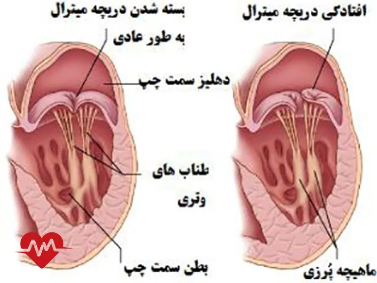 افتادگی دریچه آئورت