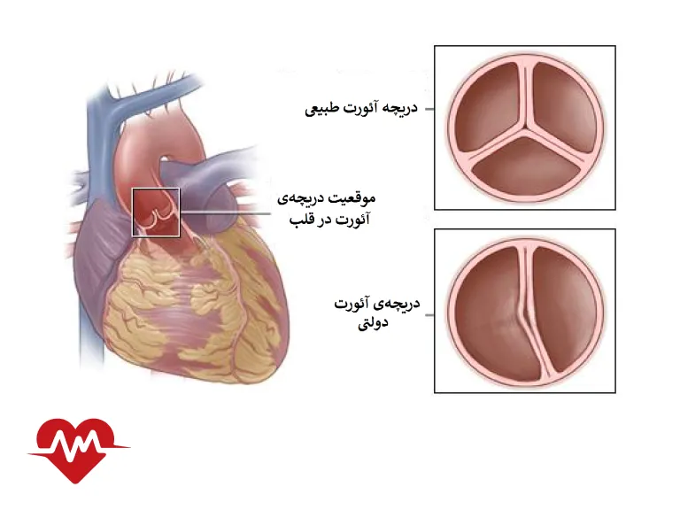 بیماری دریچه قلب