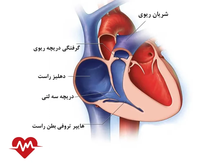 گشادی دریچه ریوی قلب چیست و چگونه درمان می شود؟