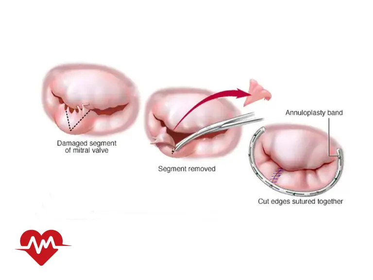 عوارض گشادی دریچه قلب