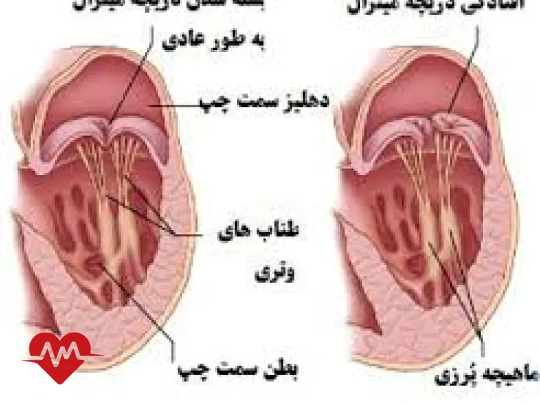 افتادگی دریچه میترال در بارداری