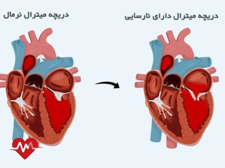 نارسایی دریچه تریکوسپید قلب