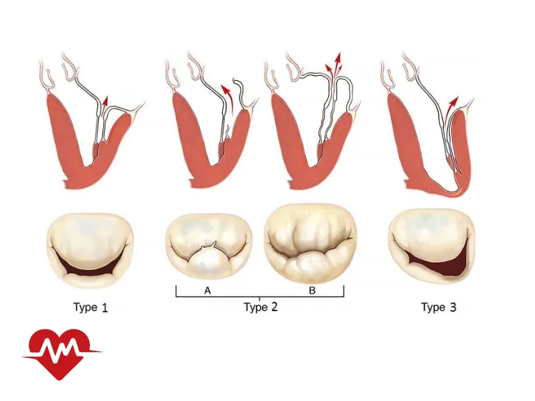 افتادگی دریچه آئورت