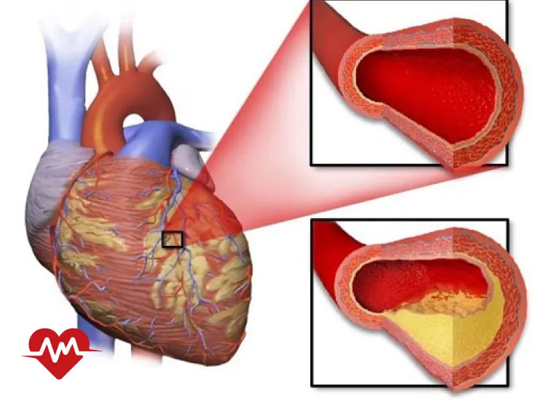 بیماری دریچه قلب