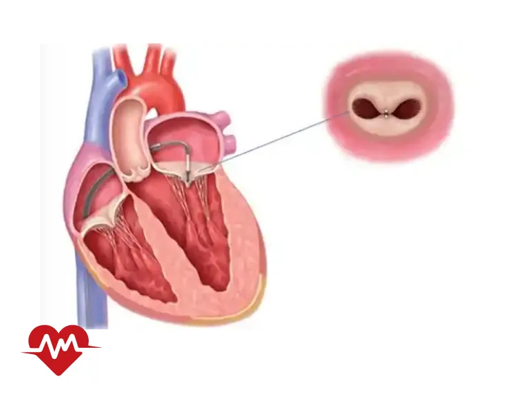 گشادی دریچه ریوی قلب چیست و چگونه درمان می شود؟