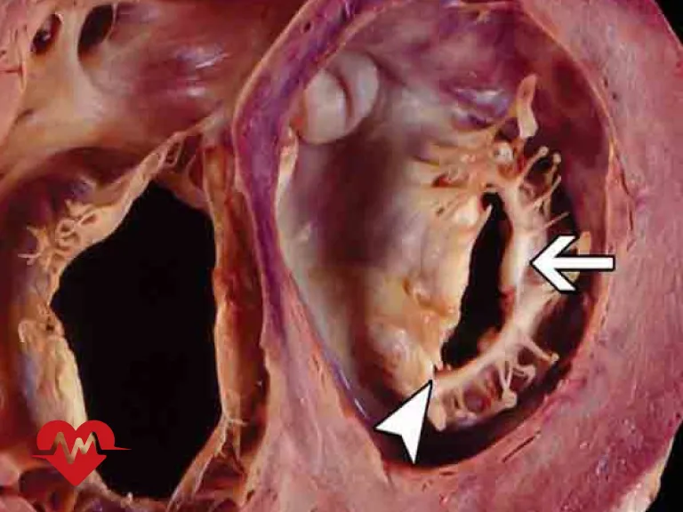 ترمیم دریچه میترال قلب بدون جراحی