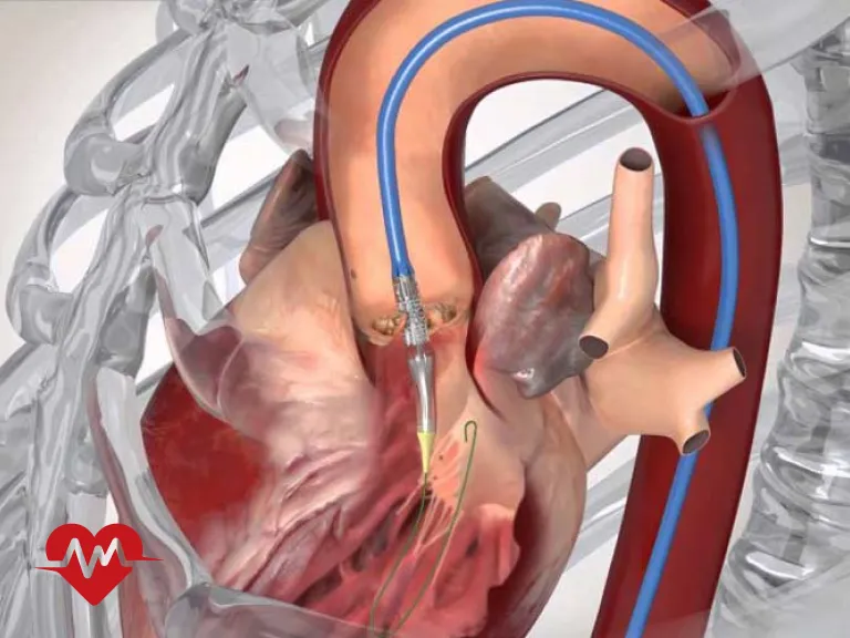 ترمیم دریچه میترال قلب بدون جراحی