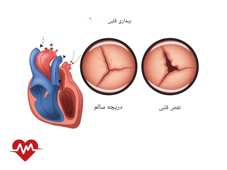 نارسایی دریچه قلب