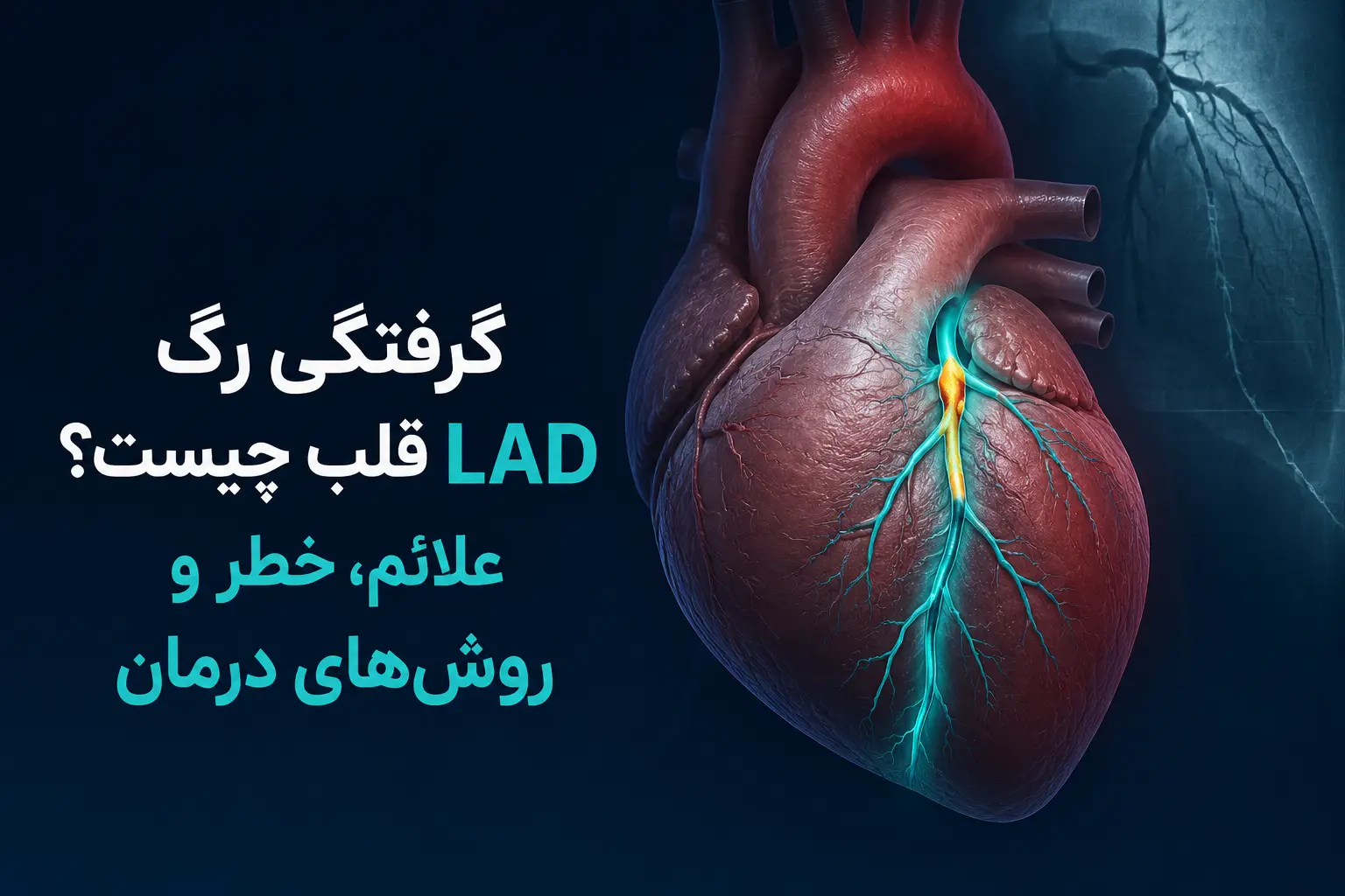 گرفتگی رگ LAD قلب